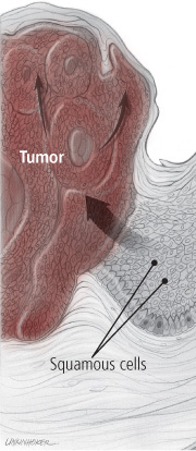 Apologise, squamous cell vulva lesion can not